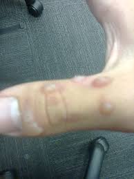 how to get rid of warts on hand